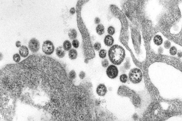 Un cas de virus lassa découvert au Togo