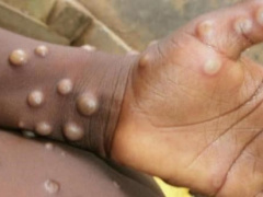 Togo prepares to face monkeypox as several countries in the West and Africa deal with the virus